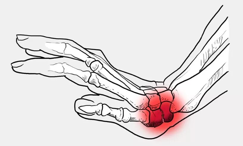 Причина ноющей боли в кисти. Переломы кисти перелом ладьевидной кости. Перелом ладьевидной кости кисти симптомы. Перелом ладьевидной кости кисти запястье. Перелом костей кисти ладьевидная кость.