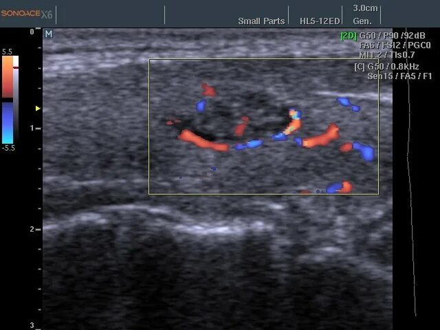 Обучение узи ultrasonicthyroid ru. Лимфоузлы в щитовидной железе на УЗИ. Эхография щитовидной железы (цветовой допплер. Атлас по УЗИ щитовидной железы. Атлас по УЗИ В анестезиологии.