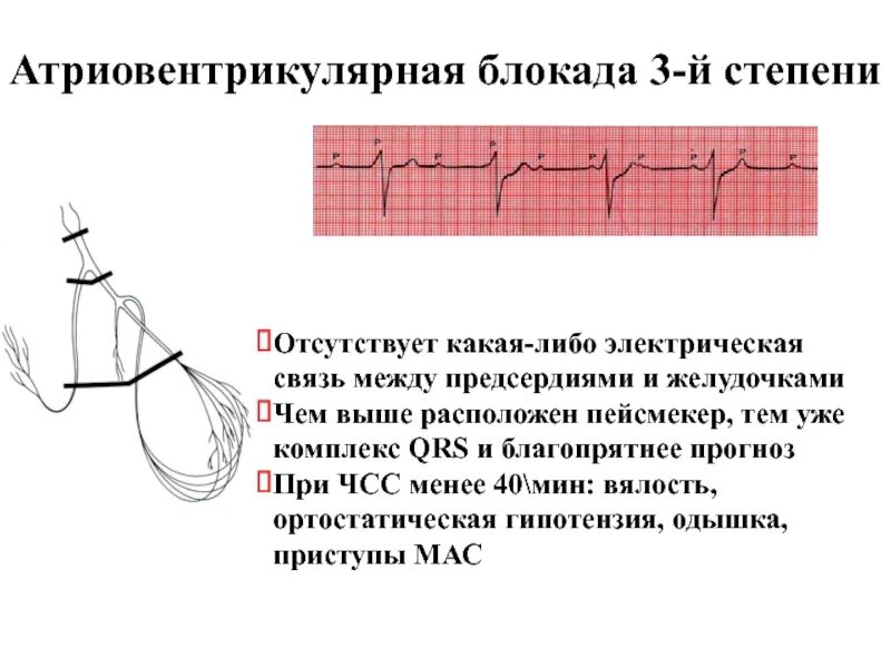 Полная атриовентрикулярная блокада. 3 Степень атриовентрикулярной блокады. Атриовентрикулярная блокада III степени (полная АВ-блокада). АВ блокада 3 степени ЧСС. АВ блокада 3 степени на ЭКГ.