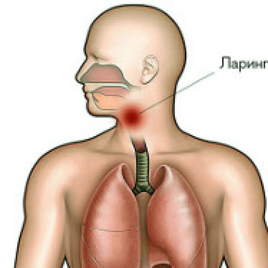Ларингит сколько дней длится. Ларингит сколько дней длится