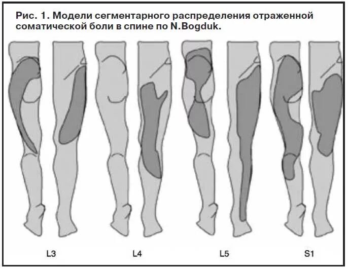 Иррадиация в ногу. Корешковый синдром. Корешковые боли. Корешковый синдром поясничного отдела. Грыжа корешковый синдром.