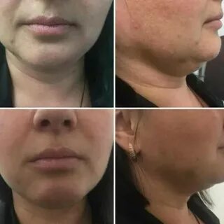 Липолитики для лица сколько процедур