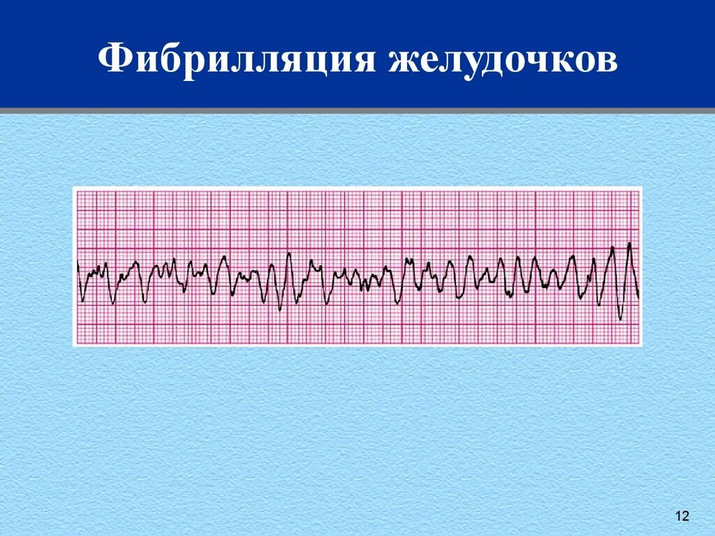 Фибрилляция мышц. Крупноволновая фибрилляция желудочков на экг. трепетание и фибрилляция желудочков на экг. фибрилляция желудочков на экг. экг при крупноволновой фибрилляции желудочков.