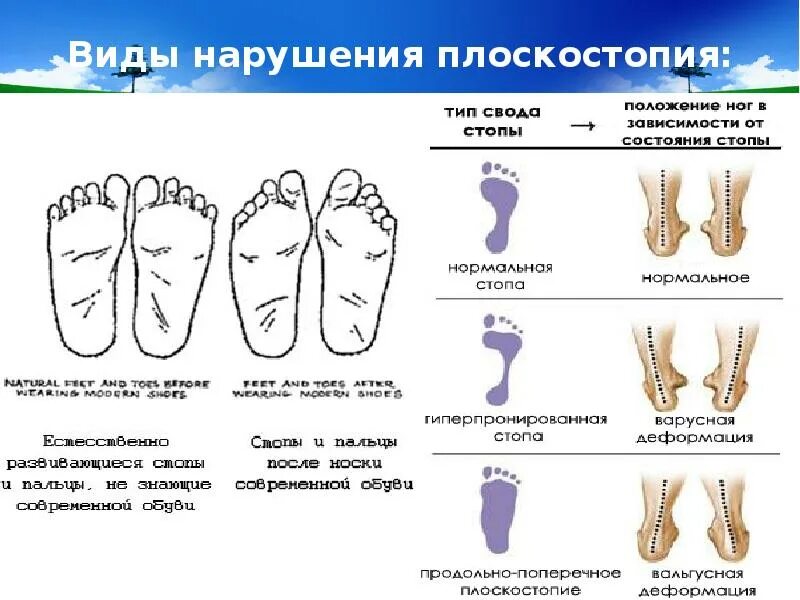 Типы стопы человека. Плоскостопие вид спереди. Продольное плоскостопие и поперечное плоскостопие. Продольно-поперечное плоскостопие и вальгус 3 степени. Свод стопы плоскостопие.