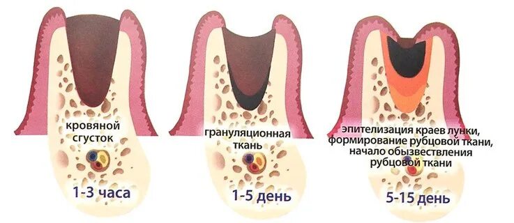 Как заживает рана после удаления зуба фото