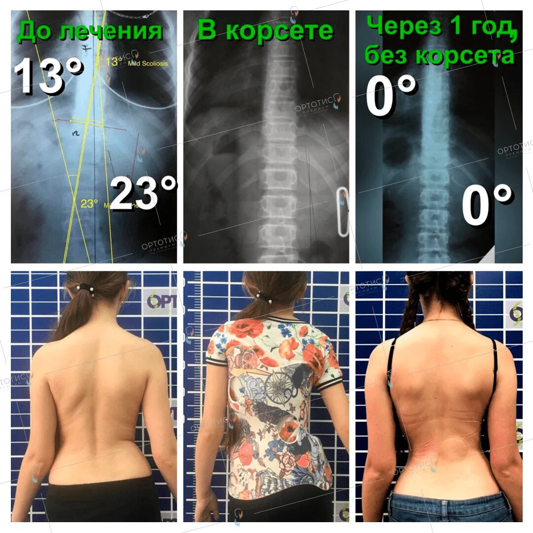 Сколиоз 4 степени корсет Шено. Корсет Шено сколиоз 2 степени. Сколиоз 3 степени корсет Шено.