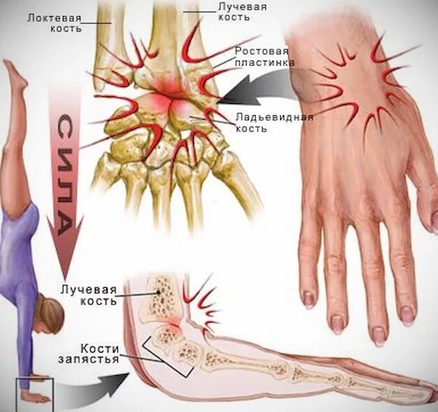 Почему заболела рука. Повреждение лучезапястного сустава. Растяжение кисти в лучезапястном суставе.