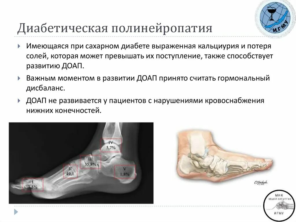 Причины нейропатии нижних конечностей у женщин. Симптом «диабетической стопы»:симптом «диабетической стопы». Гангрена пальцев стопы диабетическая. Диабетическая полинейропатия стопа.