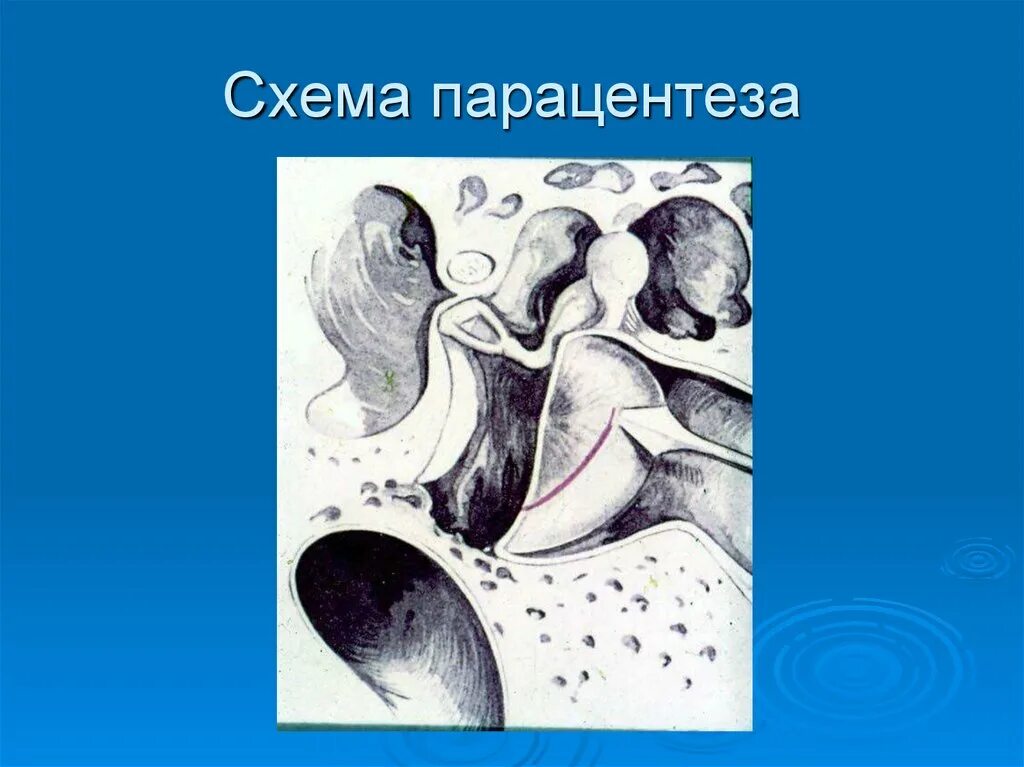 Парацентез барабанной перепонки это. Парацентез барабанной перепонки.