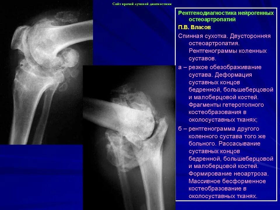 Артропатия код. Табетическая артропатия (сустав Шарко). Артропатия плечевого сустава рентген. Сирингомиелическая артропатия.