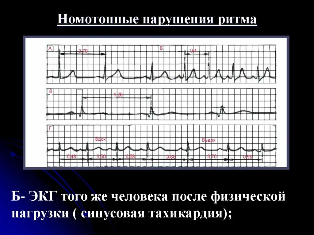 Номотопные нарушения ритма. ЭКГ после физической нагрузки. Тахикардия после нагрузки в ЭКГ. Кардиограмма после физической нагрузки. Нагрузочное экг