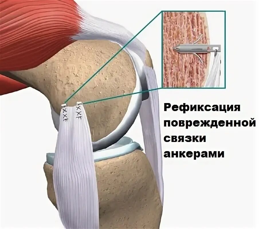 Связки коленного сустава сколько восстанавливается. Перерастяжение связок коленного сустава. травмы боковых связок коленного сустава. разрыв латеральной коллатеральной связки коленного сустава. разрыв боковой связки коленного сустава.