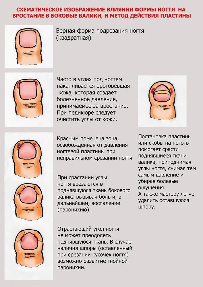 Ногтевой валик на ноге. Обработка вросшего ногтя схема. Вросший ноготь на большом пальце ноги.