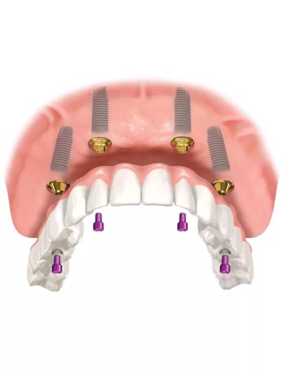 All on 6 цена. Имплантологическая кассета Nobel полный набор для all on 4. Имплантация верхней челюсти на 4 имплантах. Условно съемный протез на 4 имплантах. Имплантация челюсти на 4 имплантах.