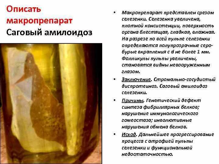 Саговый амилоидоз селезенки. Саговая селезенка макропрепарат микропрепарат. амилоидоз селезенки макропрепарат саговая. амилоидоз селезенки макропрепарат. амилоидоз это патанатомия макропрепарат.