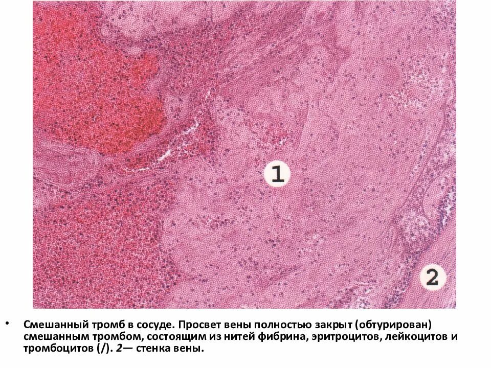 Организованный тромб в Вене микропрепарат. Красный обтурирующий тромб микропрепарат. Красный тромб в Вене микропрепарат. Смешанный тромб в Вене микропрепарат рисунок. Пристеночный тромбоз