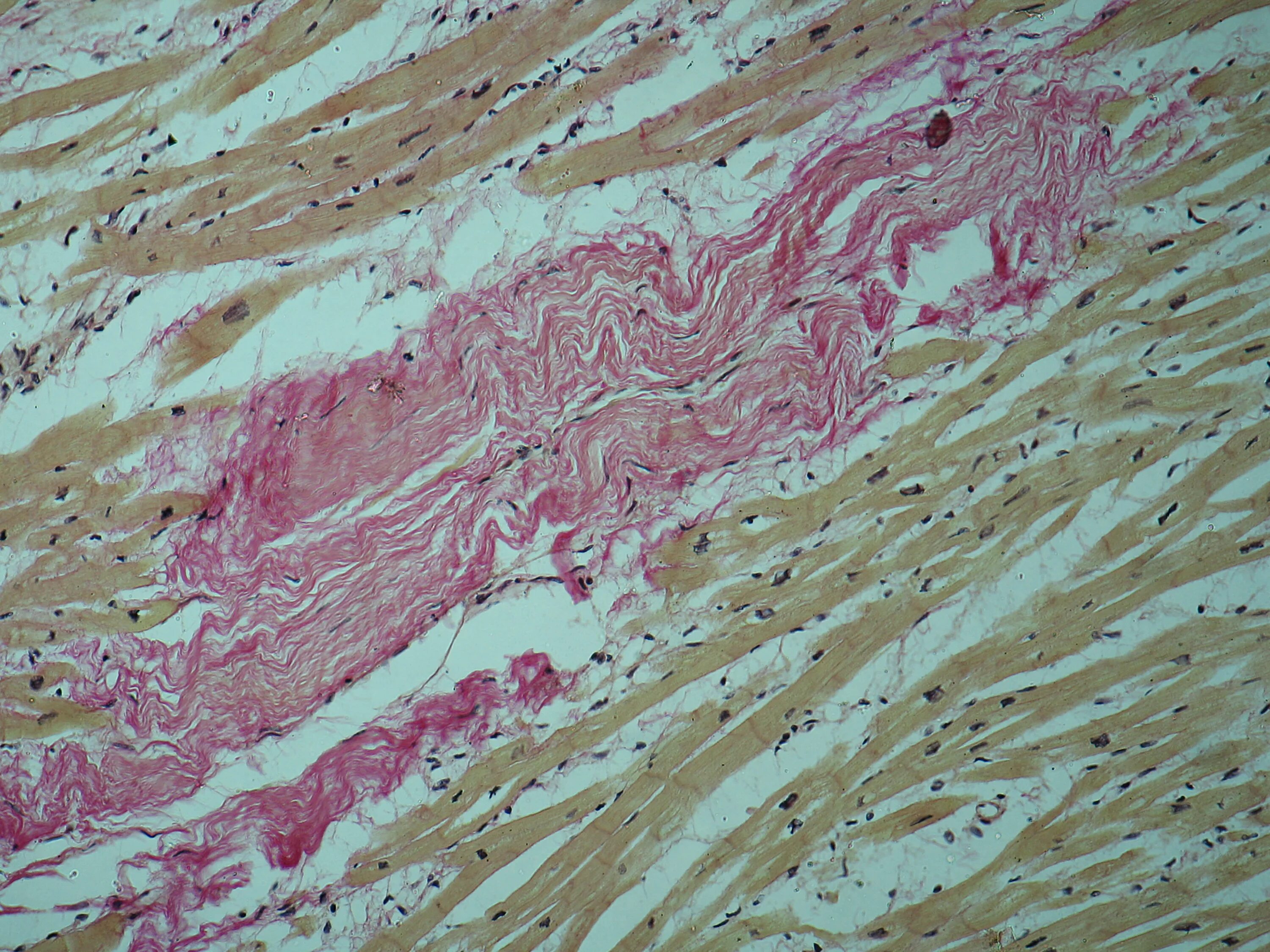 Диффузный мелкоочаговый. Кардиосклерозгемаоксилин эозин. Постинфарктный кардиосклероз микропрепарат. Постинфарктный кардиосклероз гистология. Пикрофуксином по Ван Гизону.