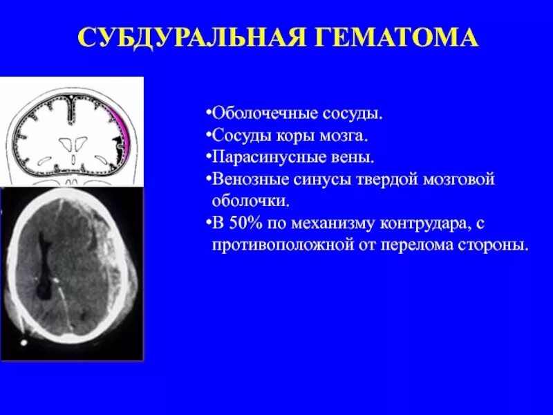 Субдуральная гематома мозга. Субдуральная гематома анатомия. Субуральная гемотома головной МОЗ. Субдуральная гематома твердой оболочки. Субдуральная гематома лечение