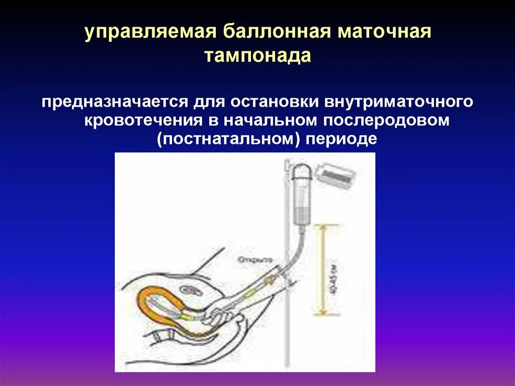 Катетер маточный баллонный. Катетер баллонный гемостатический внутриматочный. Баллон жуковского катетер маточный баллонный. Баллон жуковского катетер маточный баллонный. Управляемая баллонная маточная тампонада.