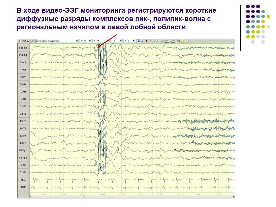 Угмк ээг. Комплексы пик волна на ээг. комплекс острая медленная волна на ээг. ээг пароксизмальная активность пик волна. острая волна медленная волна на ээг.