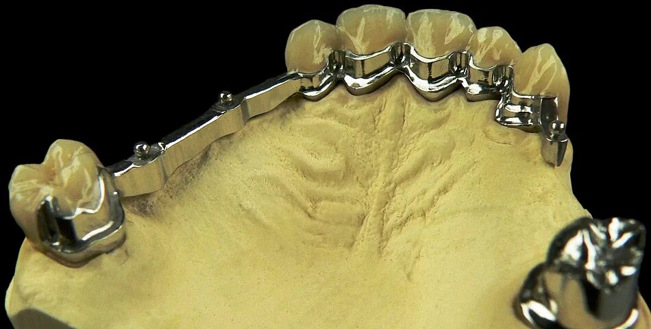 бюгельный протез а16. балочная система фиксации протезов на имплантах. балочная система фиксации на имплантах. бюгельные протезы с балочной системой фиксации. балочная система фиксации бюгельных протезов.