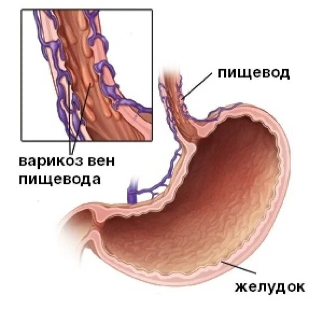 Расширен пищевод желудка