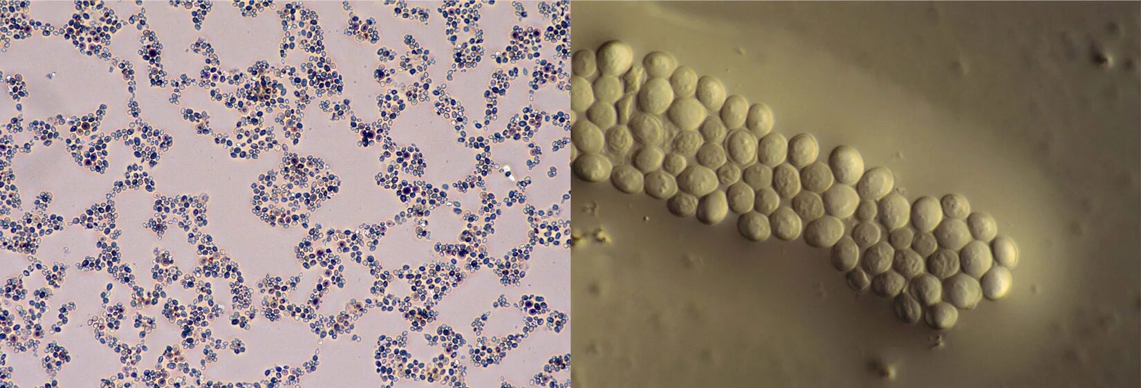 Псориаз под микроскопом как выглядит Psoriasis skin cells. Psoriasis is a disease in which the skin starts to produce