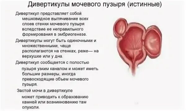 Дивертикул мочевого пузыря операция. Воспалительные заболевания мочевого пузыря. Болезни мочевого пузыря у женщин. Мочевой пузырь болезни симптомы.