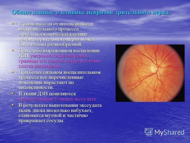 Ретробульбарный неврит симптомы. Ретробульбарный неврит (папиллит). клиника поражения зрительного нерва. неврит зрительного нерва и ретробульбарный неврит. ретробульбарный неврит зрительного нерва клиника.