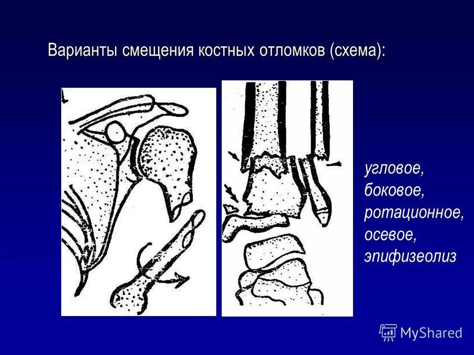 Смещение костного отломка. Основные типы смещения костных отломков. Смещение костных рбломков. Типы смещения отломков при переломах. Смещение костного отломка.