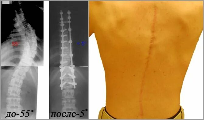 Операция на позвоночник сколько времени. Операция на позвоночнике сколиоз 4 степени. Операция на сколиоз 3 степени.