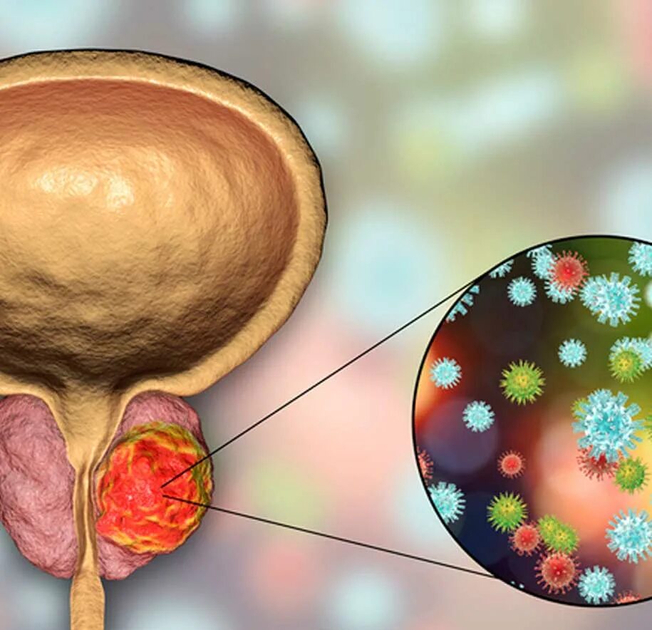 Образование в предстательной железе. Опухоль простаты у мужчин. Злокачественная опухоль предстательной железы. Предстательная железа форма шаровидная. Ткань простаты