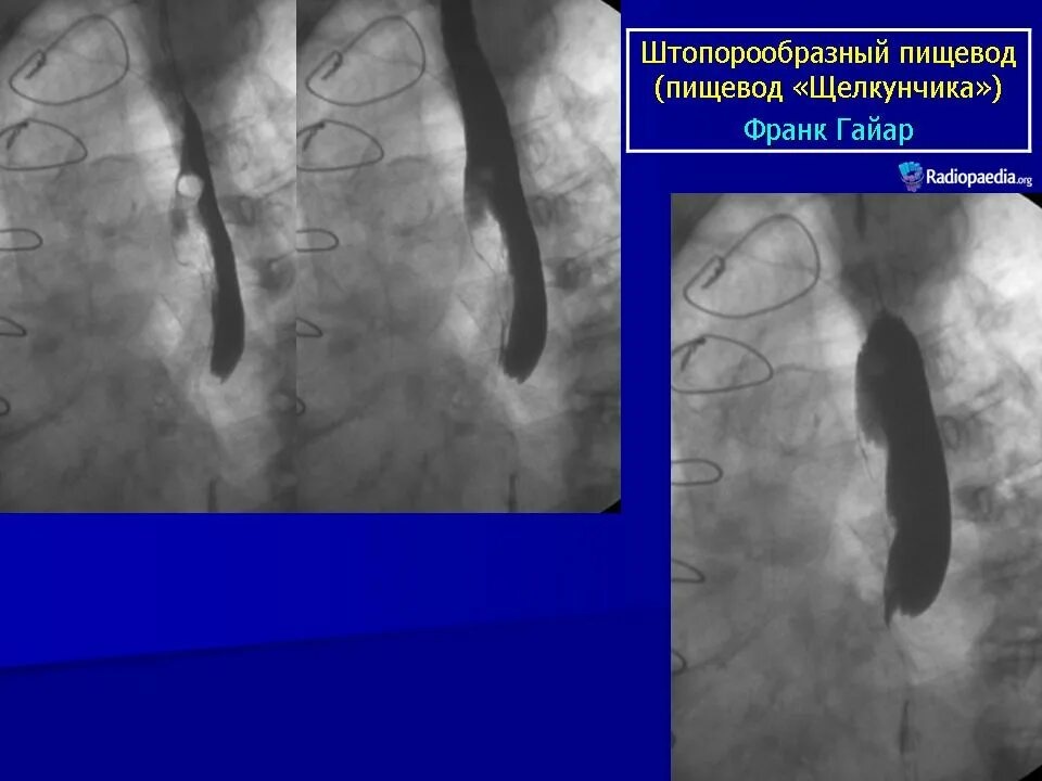 Кольцо шацкого в пищеводе. Ахалазия и дивертикул пищевода. Ценкеровский дивертикул пищевода. Бифуркационный дивертикул пищевода. Дивертикул желудка рентген.