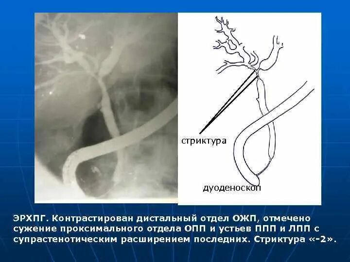 Дистальный стеноз