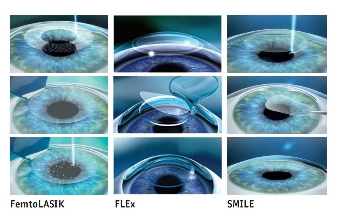 Восстановление после лазерной операции. Фемто ласик лазерная коррекция. Коррекция зрения Фемто ласик. Ласик (LASIK)/Фемто ласик (Femto LASIK).
