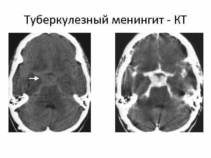 Туберкулез головного. Базилярный туберкулезный менингит. Серозный туберкулёзный менингит. Туберкулез мозговых оболочек мрт. Кт головного мозга при туберкулезном менингите.