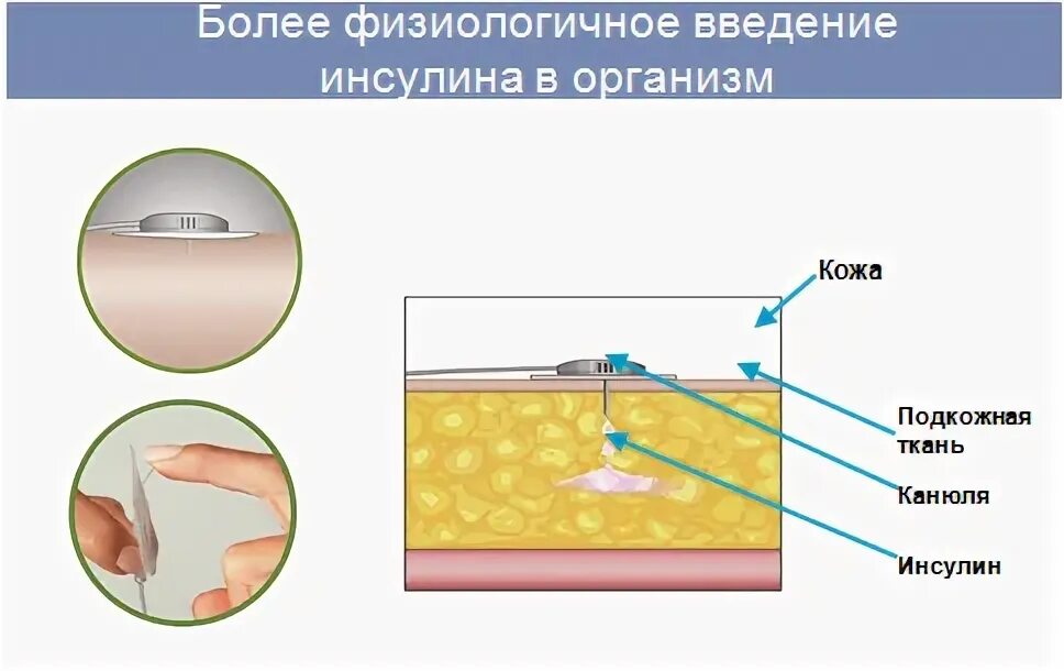 Принцип инсулиновой помпы. Инсулиновая помпа строение. инсулиновая помпа схема строения. устройство инсулиновой помпы. инсулиновая помпа из чего состоит.