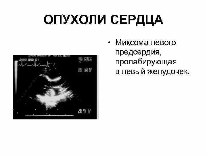 Тромб в желудочке. Миксома левого предсердия на ЭХОКГ. Миксома митрального клапана. Миксома правого желудочка. Миксома правого предсердия кт.