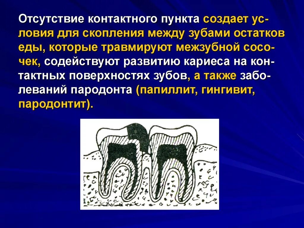 Плотный отсутствие. Восстановление контактного пункта у зубов. Межзубные контактные пункты.