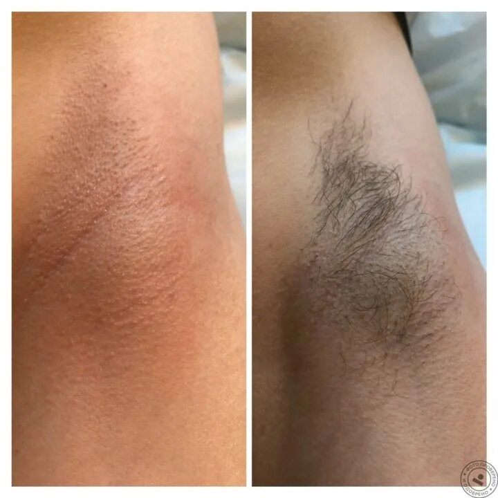 Лазерная эпиляция. Подмышки до и после шугаринга. Эпиляция подмышек до и после. Депиляция ног. Подмышки до и после депиляции.
