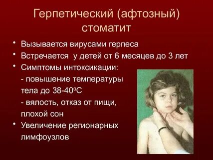 Вирусный стоматит лечение