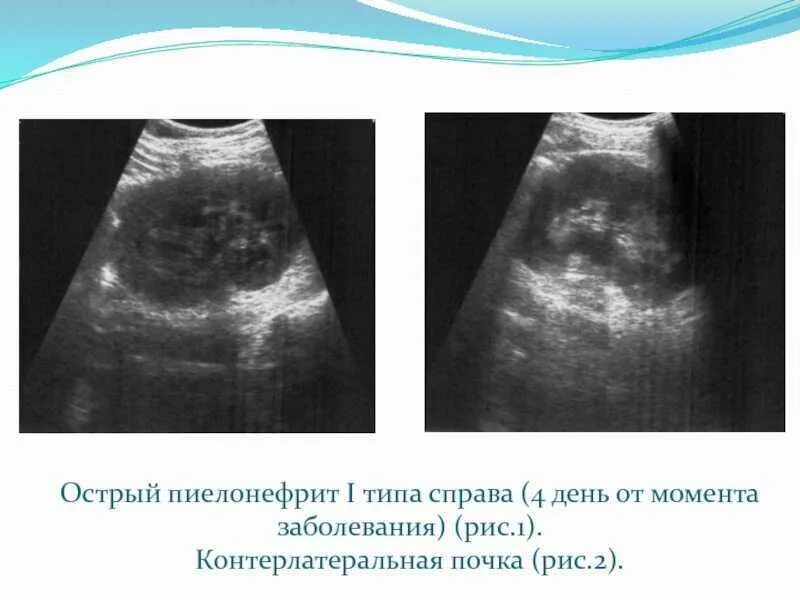 УЗИ почек острый пиелонефрит заключение. УЗИ признаки нефрита почек. УЗИ почек хронический пиелонефрит. УЗИ признаки острого пиелонефрита.