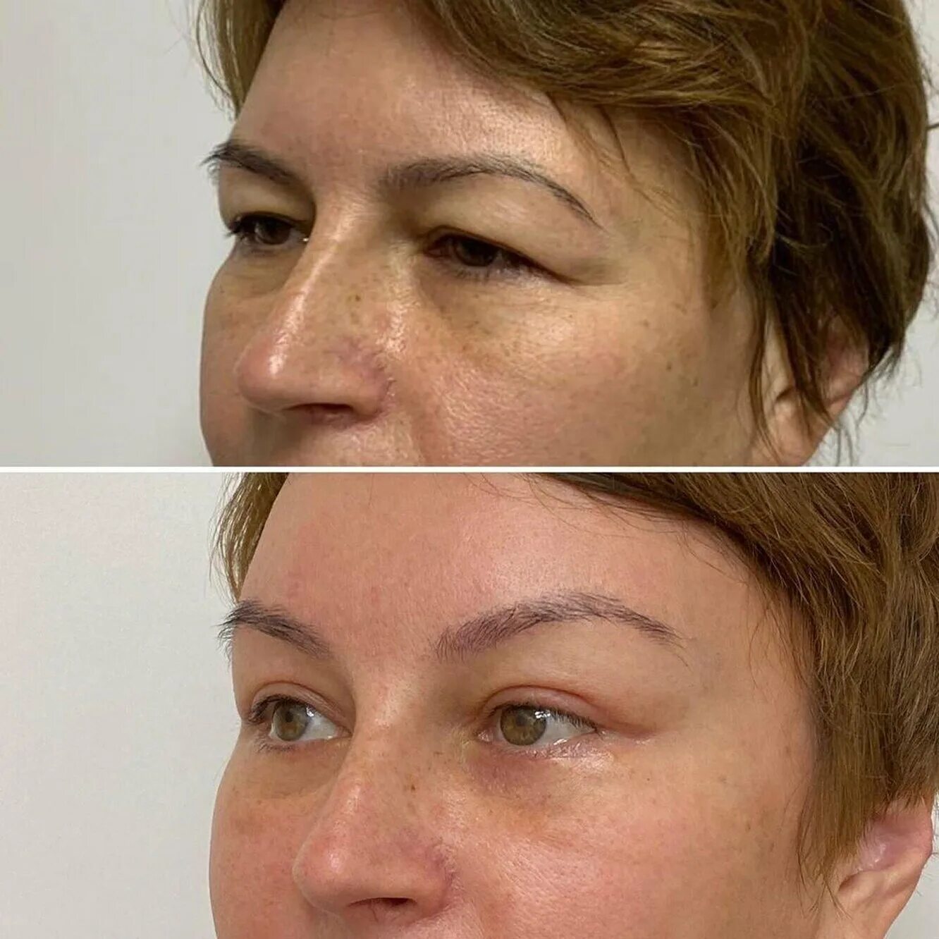 лифтинг бровей ботоксом