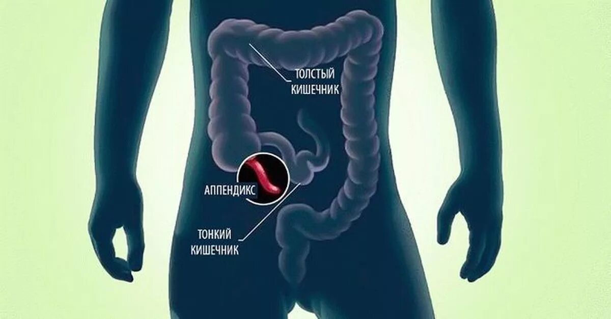 Тянет живот кишечник. Где находится аппендикс. Где находитсяаапендикс. Фото аппендикса расположение.