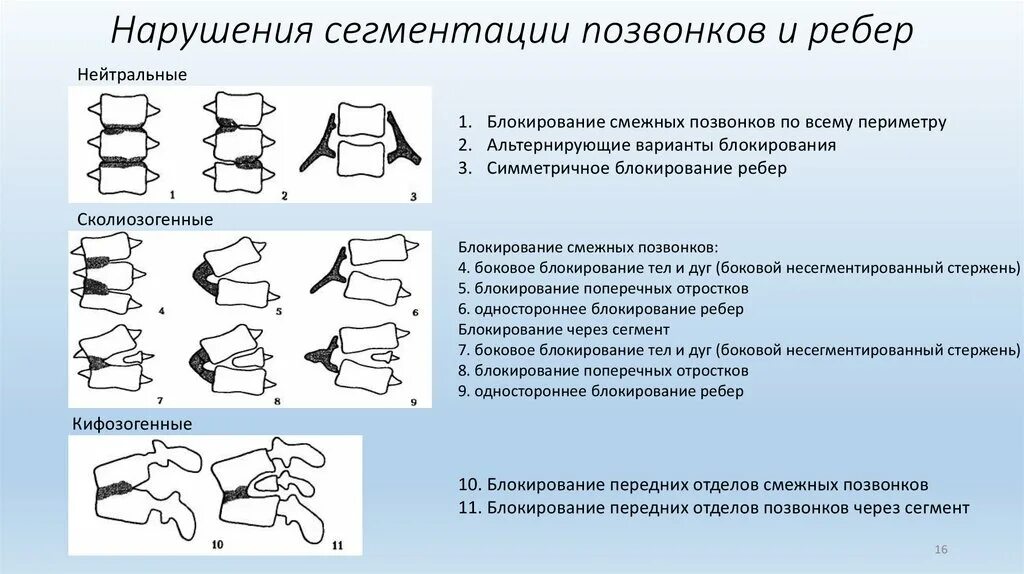 Аномалия сегментации позвонков. Аномалии развития позвонков. Типы деформации тел позвонков. Врожденная аномалия развития позвоночника.