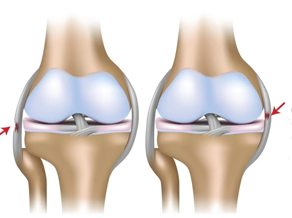 Травма медиальной коллатеральной связки. Повреждение коллатеральной связки коленного сустава. Разрыв медиальной коллатеральной связки коленного. Повреждения мениска коленного сустава как лечить