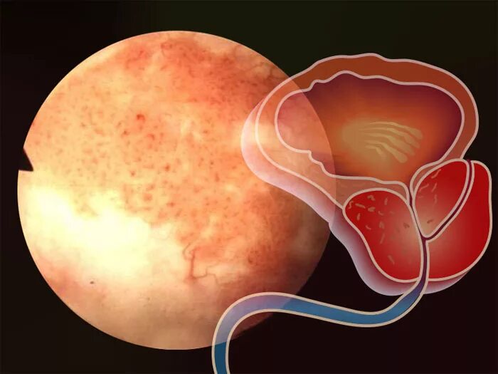 Простатит у человека. Простата.