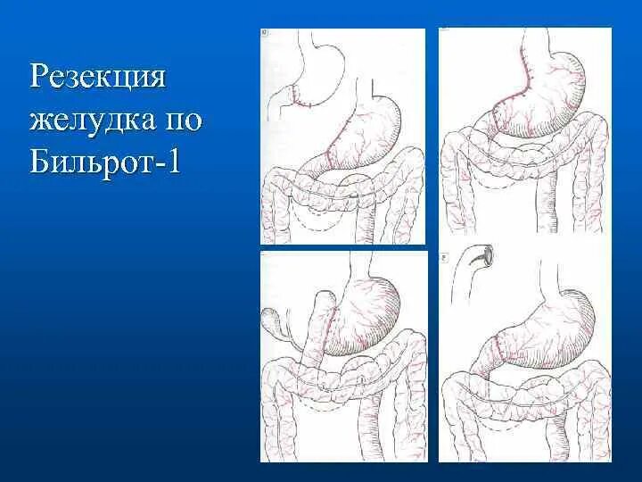 Умер от резекции желудка. Схема резекции желудка по Бильрот 1. Операция резекция желудка Бильрот 1 и 2.