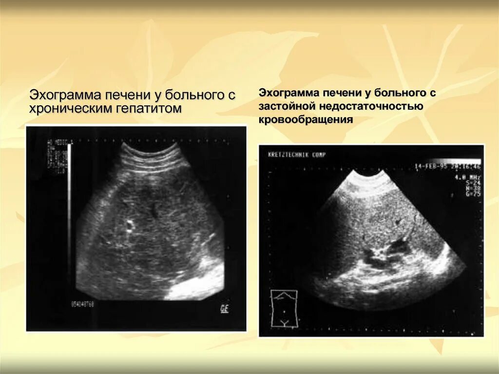 Изменения печени у ребенка. УЗИ картина гепатита печени. УЗИ печени УЗИ печени. Хронический гепатит УЗИ протокол. Хронический гепатит на УЗИ.