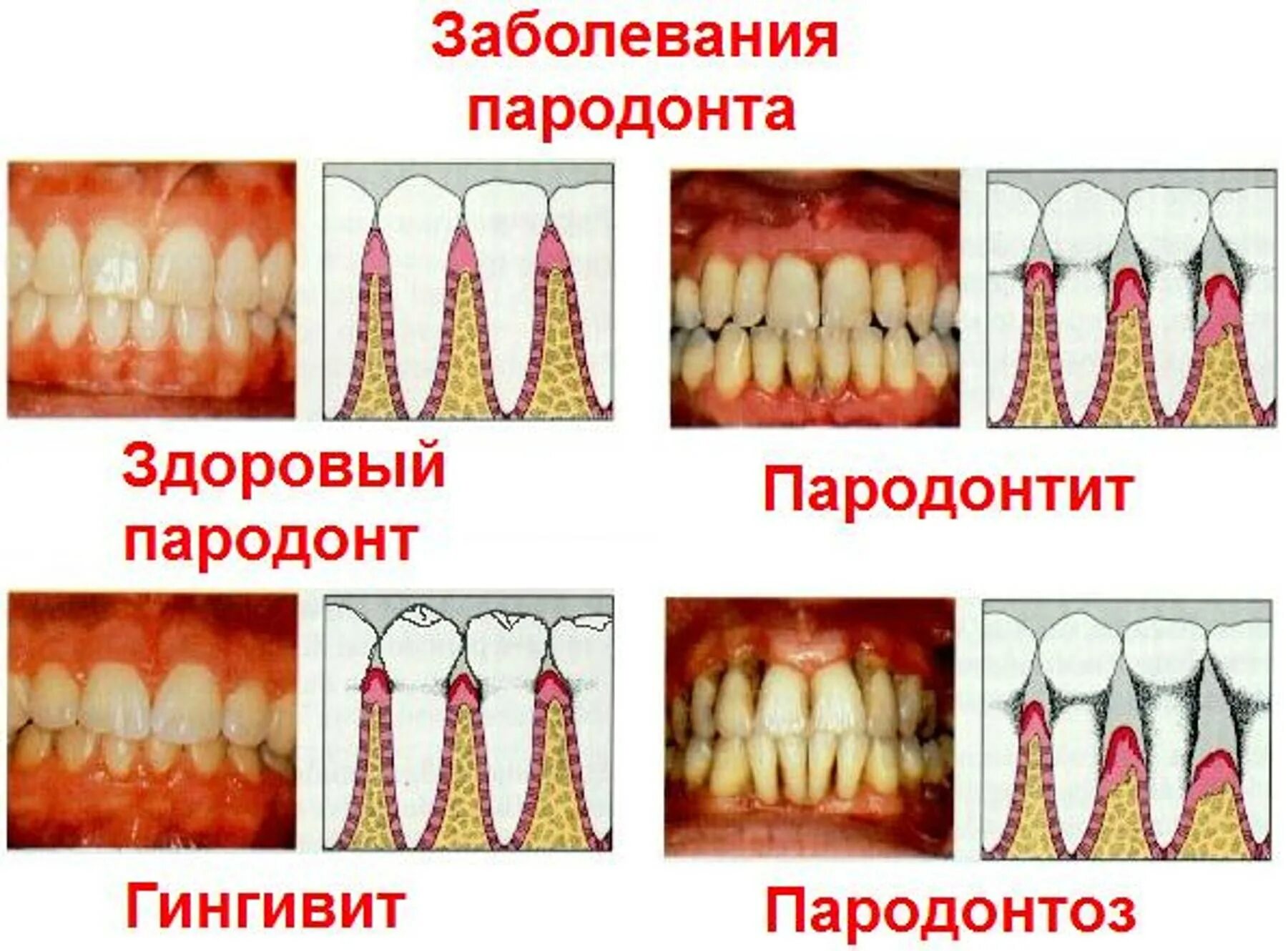 Воспалительные заболевания пародонта гингивит пародонтит. Язвенно некротический гинг. Быстропрогрессирующий пародонтит. Острый катаральный гингивит.